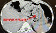 浙江一5岁女孩确诊长发公主综合征：胃里一大团头发 医生都懵了 ！