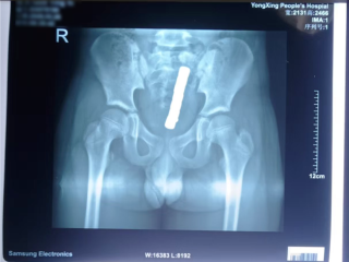 10岁孩子将8颗磁力珠塞入肛门致肠穿孔：小命差点不保 ！