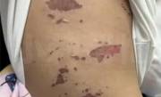 3岁男童吃火锅烫嘴后竟全身溃烂 医生：有传染性 !