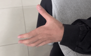高中生左手莫名发抖半年确诊平山病：长期保持错误坐姿 !
