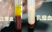 男子抽出草莓奶油血 医生紧急提醒：血脂长期偏高要注意 ！