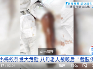 老人手被被蚂蚁咬一口 没在意竟需截肢保命 医生：咬伤后 警惕“危险信号” !