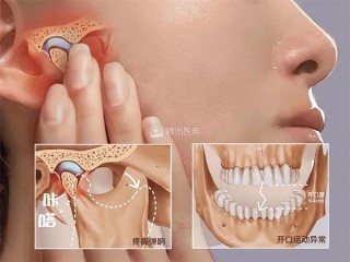 00后女生一觉醒来无法张嘴：确诊“T M D” ！