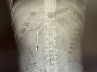 体内待了20年！男子12岁时误吞水银体温计 32岁因腹痛才取出 ！