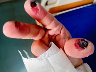 女子误踩身亡！警惕清洁剂中隐藏的“化骨水” 你家可能也有 !