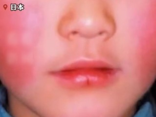 日本“苹果病”流行达到历史顶点：从双颊开始形成网状红斑 !