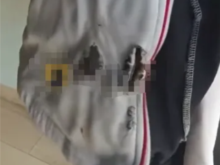 刚买一个月的充电宝突然自燃 17岁高中生校服被烧出大洞 !