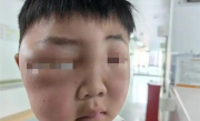 男孩一觉醒来脸肿成“发面馒头”：被蚊虫叮的面目全非 ！