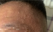 男子每天炫10斤西瓜致带状疱疹 医生：糖尿病患者感染风险更高 !