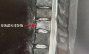 每天4杯咖啡 25岁女孩确诊骨质疏松 弯个腰骨折了 ！