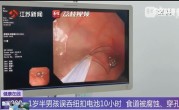 幼儿误吞电池10小时致终身残疾 医生提醒：纽扣电池卡在食道太骇人 !